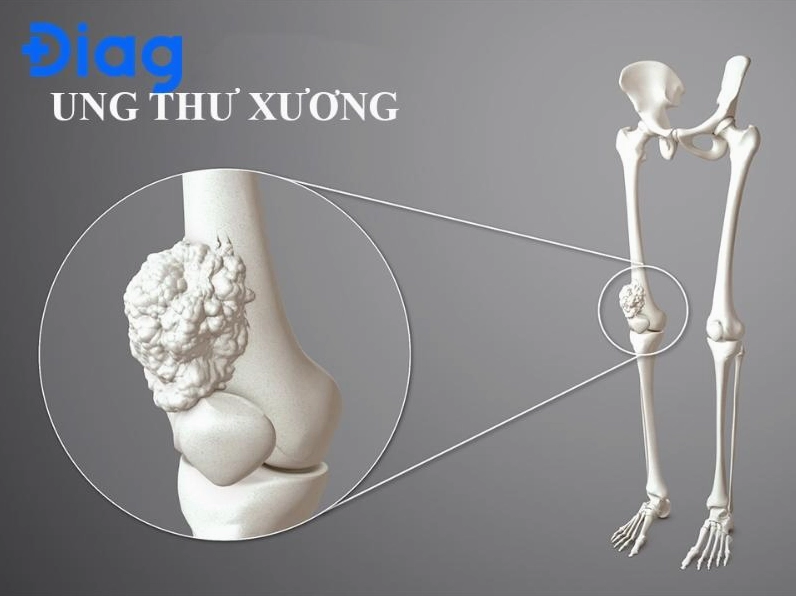 Hình ảnh minh họa vị trí khối u ác tính trong xương dài của cơ thể người