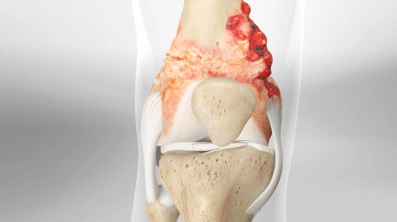 Một bệnh nhân bị sưng tấy vùng đầu gối do khối u xương ác tính gây ra