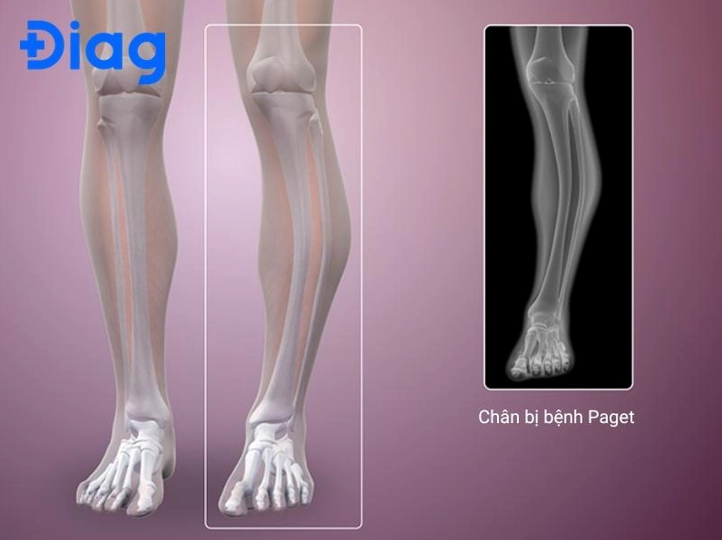 Người bệnh ung thư xương đang được bác sĩ tư vấn về phác đồ điều trị