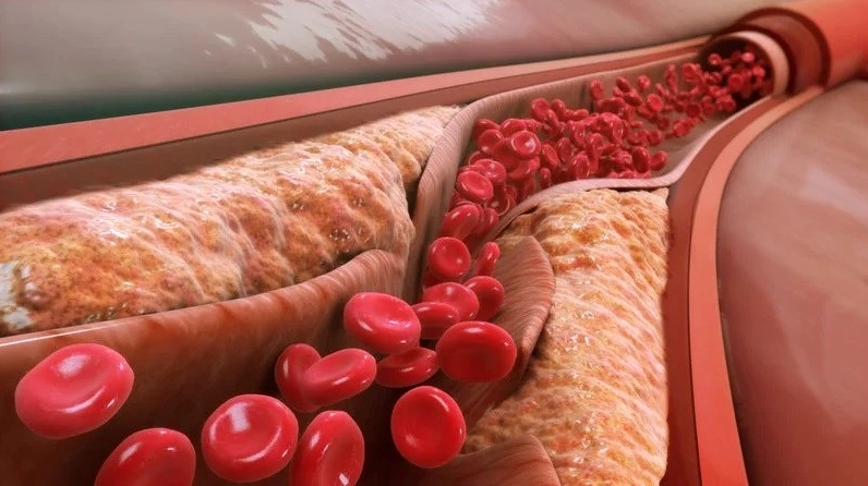 Quả bơ giúp giảm lượng cholesterol xấu và tăng cholesterol tốt trong máu